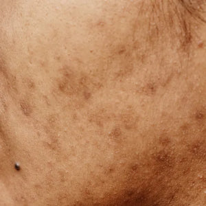 Pigmentation