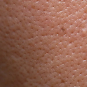 Enlarged Pores